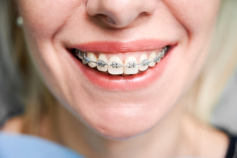 Close up of woman with charming smile demonstrating white teeth with orthodontic brackets. Female patient showing results of dental braces treatment. Concept of orthodontic treatment and dentistry.