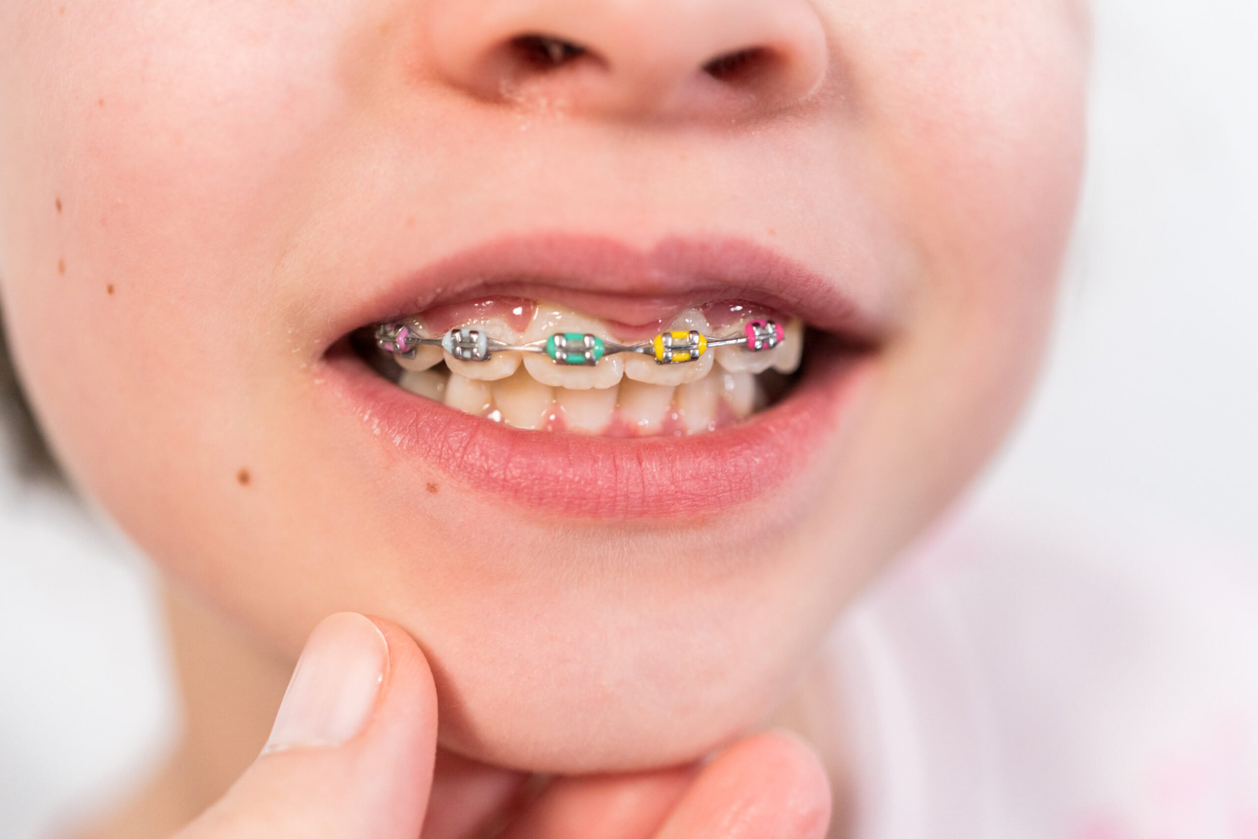 Close-up of the mouth of a teenage girl with rainbow braces.