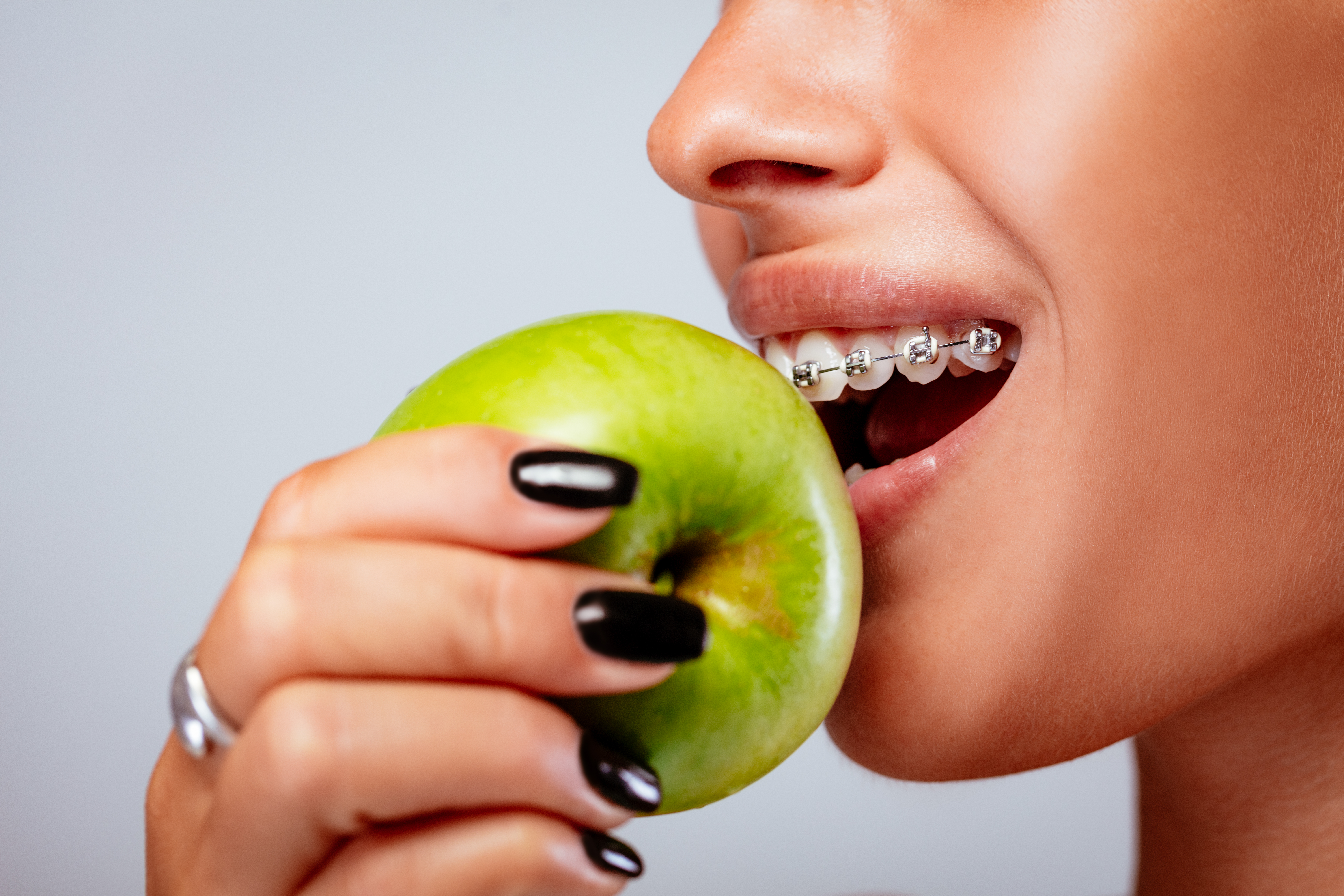 Close-up of a smiling girl face with braces on white teeth holding green apple showcasing what you can eat with braces