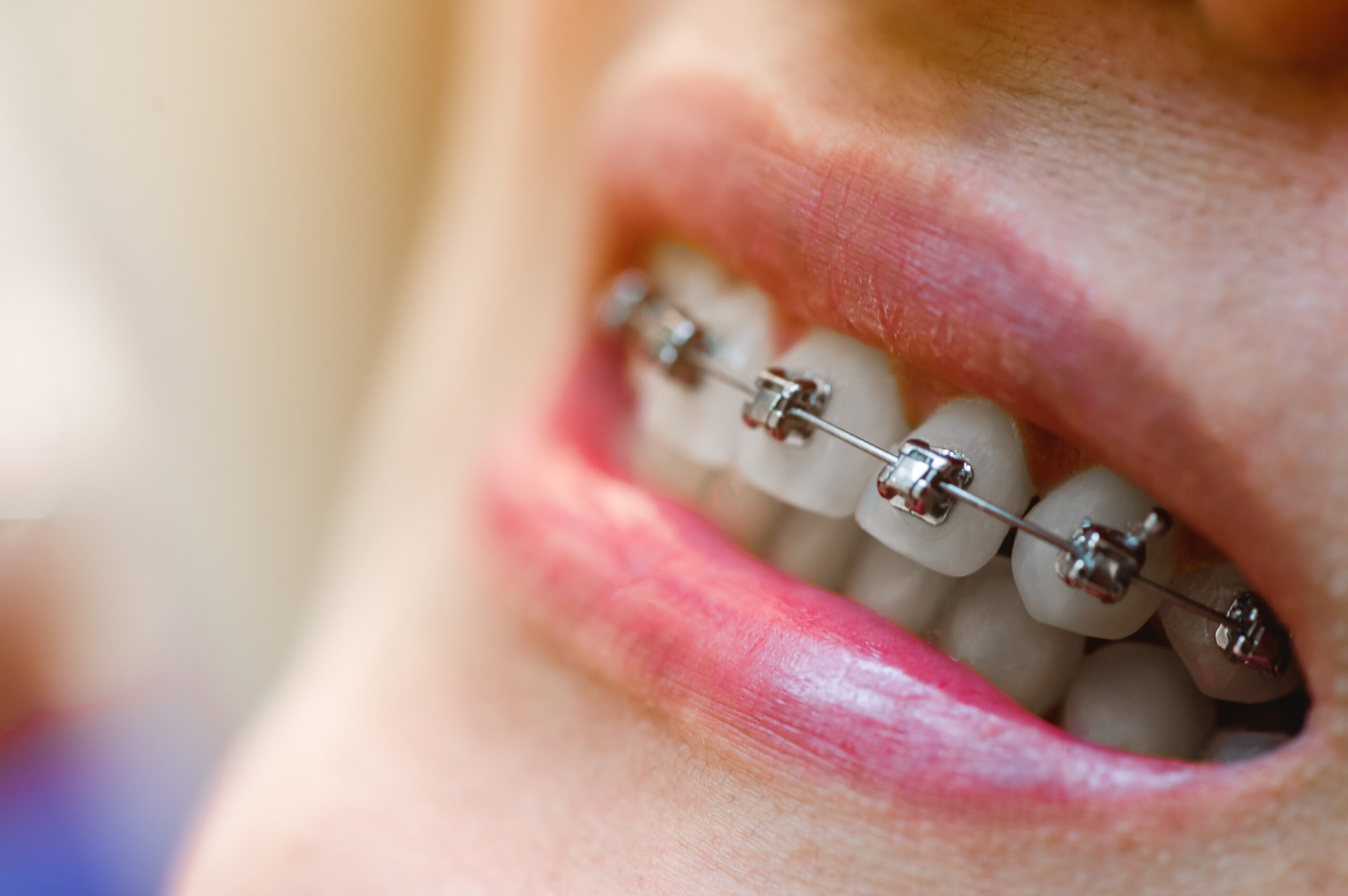 A photo of a girl with traditional braces which is a trend that's growing among teens & adults