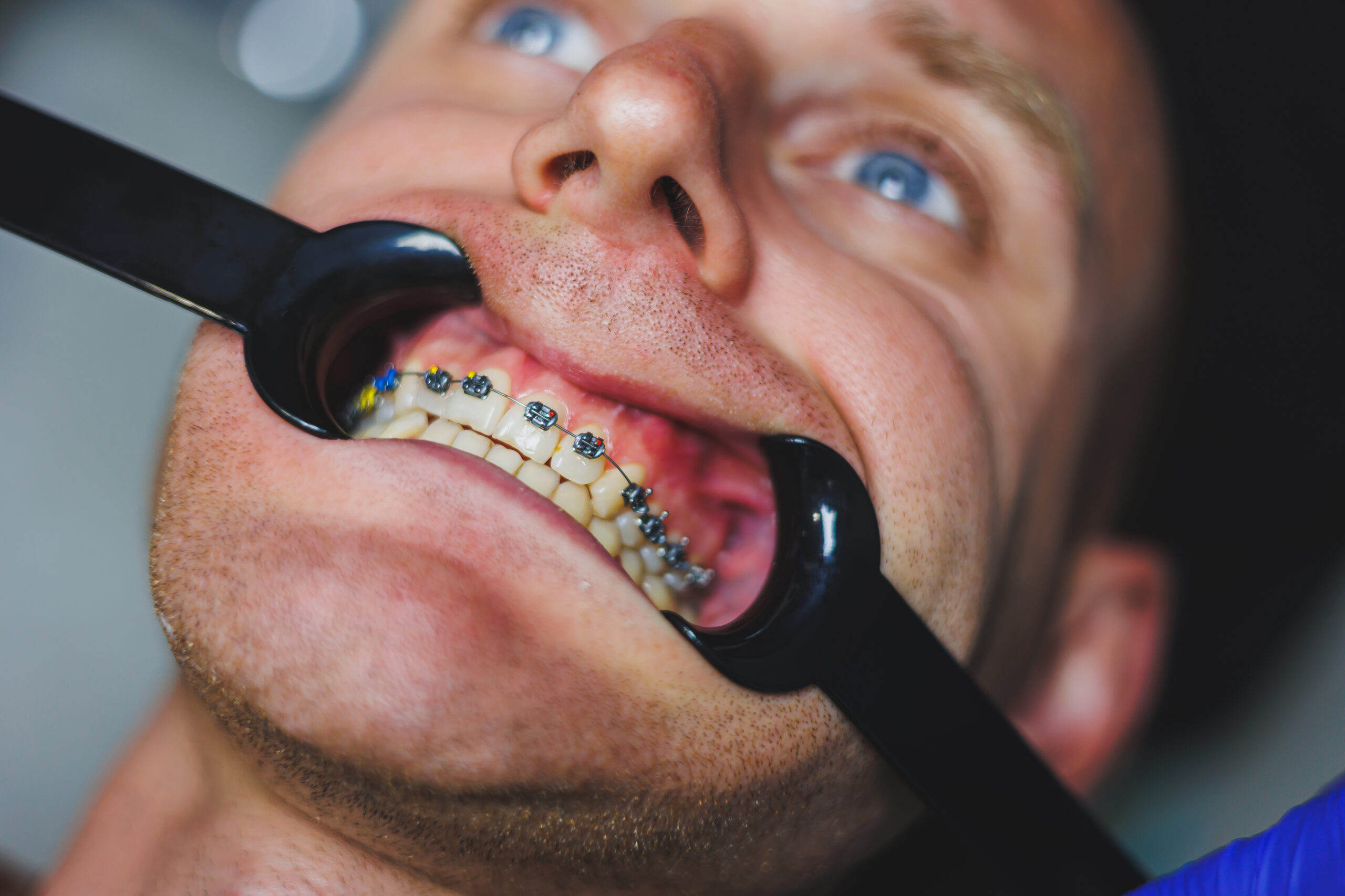 A young man receiving adult orthodontics to help transform his smile at Valley Advanced Orthodontics